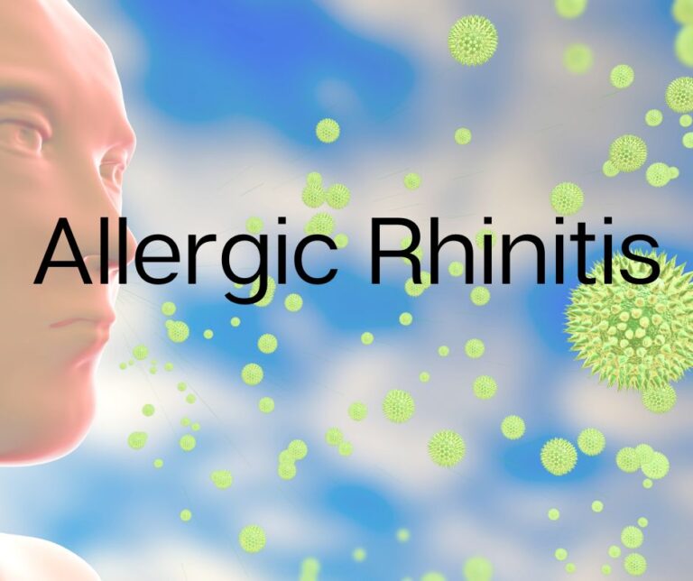 What Is Allergic Rhinitis?